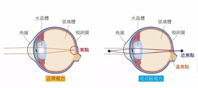 白內(nèi)障和老花眼區(qū)別，老花眼發(fā)病率正呈現(xiàn)年輕化趨勢(shì)