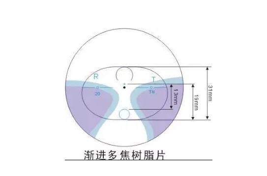 美麗島多焦鏡適合的人群，需要注意的事項(xiàng)